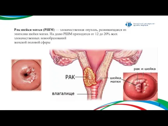 Рак шейки матки (РШМ) — злокачественная опухоль, развивающаяся из эпителия шейки матки.
