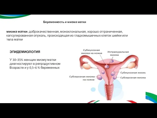 Беременность и миома матки миома матки: доброкачественная, моноклональная, хорошо отграниченная, капсулированная опухоль,