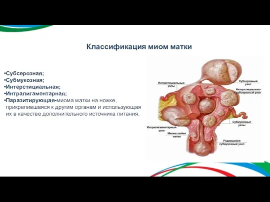 Классификация миом матки Субсерозная; Субмукозная; Интерстициальная; Интралигаментарная; Паразитирующая-миома матки на ножке, прикрепившаяся