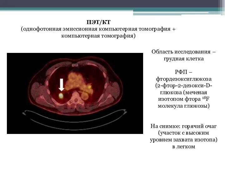 Область исследования – грудная клетка РФП – фтордезоксиглюкоза (2-фтор-2-дезокси-D-глюкоза (меченая изотопом фтора