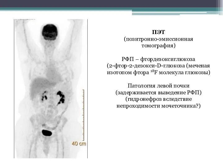 ПЭТ (позитронно-эмиссионная томография) РФП – фтордезоксиглюкоза (2-фтор-2-дезокси-D-глюкоза (меченая изотопом фтора 18F молекула