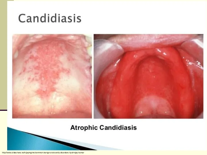 http://www.slideshare.net/vijaymgims/common-benign-oral-cavity-disorders-by-drvijay-kumar