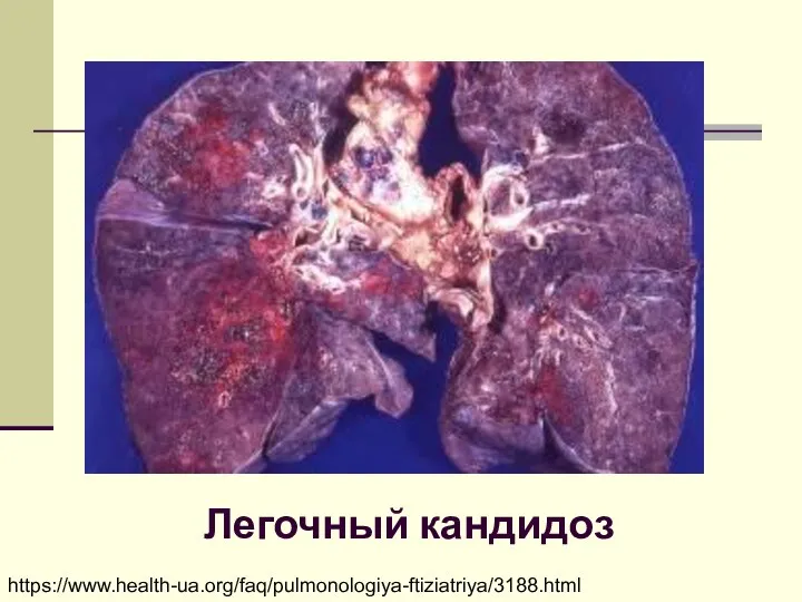 Легочный кандидоз https://www.health-ua.org/faq/pulmonologiya-ftiziatriya/3188.html