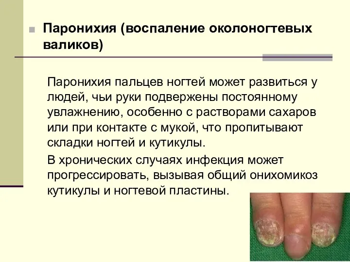 Паронихия (воспаление околоногтевых валиков) Паронихия пальцев ногтей может развиться у людей, чьи