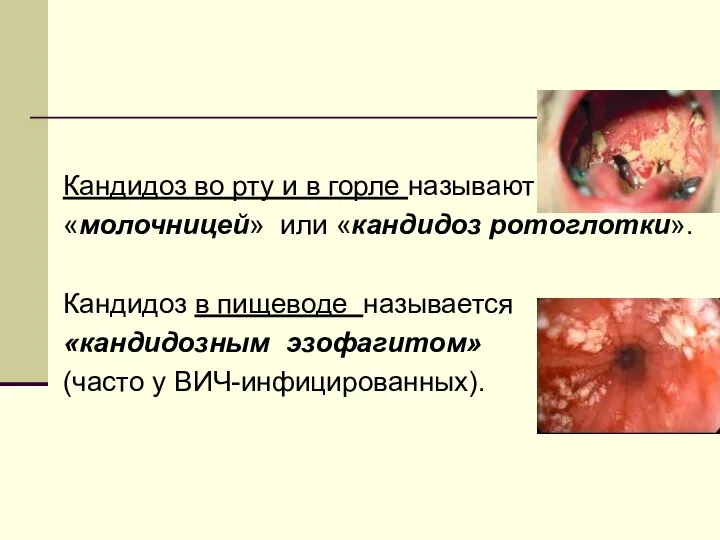 Кандидоз во рту и в горле называют «молочницей» или «кандидоз ротоглотки». Кандидоз