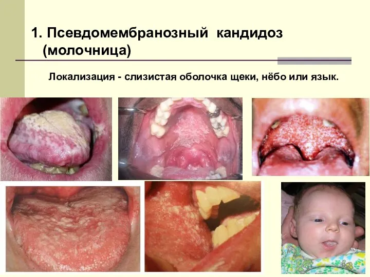 1. Псевдомембранозный кандидоз (молочница) Локализация - слизистая оболочка щеки, нёбо или язык.