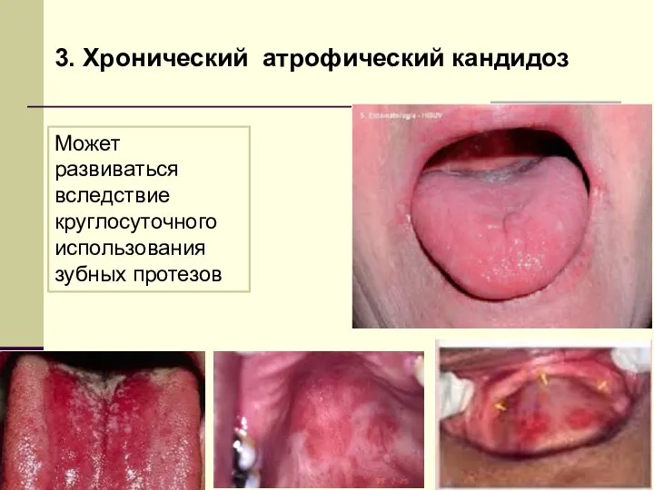 3. Хронический атрофический кандидоз Может развиваться вследствие круглосуточного использования зубных протезов