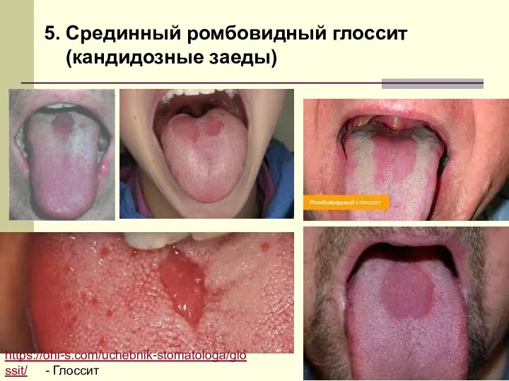 5. Срединный ромбовидный глоссит (кандидозные заеды) https://ohi-s.com/uchebnik-stomatologa/glossit/ - Глоссит