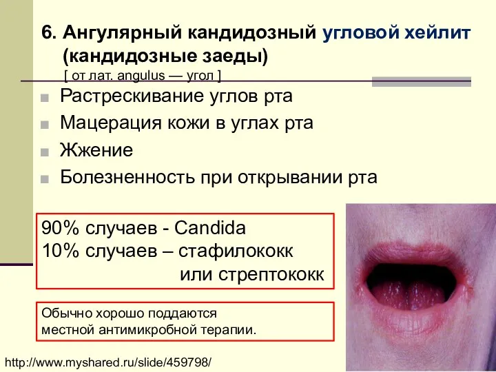 Растрескивание углов рта Мацерация кожи в углах рта Жжение Болезненность при открывании