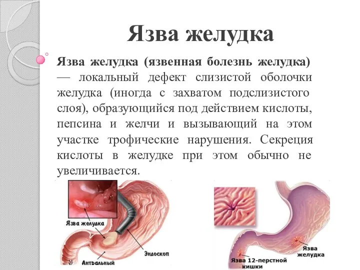 Язва желудка Язва желудка (язвенная болезнь желудка) — локальный дефект слизистой оболочки