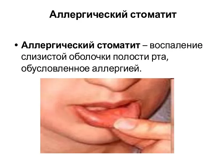 Аллергический стоматит Аллергический стоматит – воспаление слизистой оболочки полости рта, обусловленное аллергией.