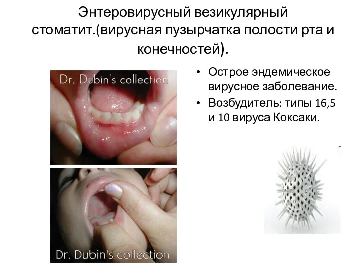 Энтеровирусный везикулярный стоматит.(вирусная пузырчатка полости рта и конечностей). Острое эндемическое вирусное заболевание.