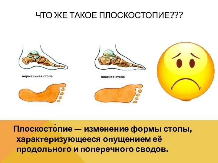 ЧТО ЖЕ ТАКОЕ ПЛОСКОСТОПИЕ??? Плоскосто́пие — изменение формы стопы, характеризующееся опущением её продольного и поперечного сводов.