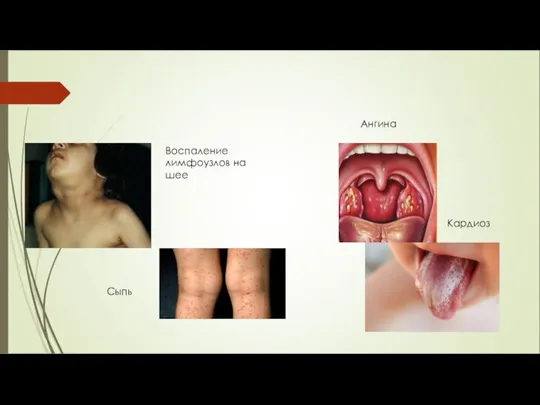 Ангина Кардиоз Воспаление лимфоузлов на шее Сыпь