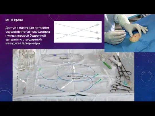 МЕТОДИКА Доступ к маточным артериям осуществляется посредством пункции правой бедренной артерии по стандартной методике Сельдингера.