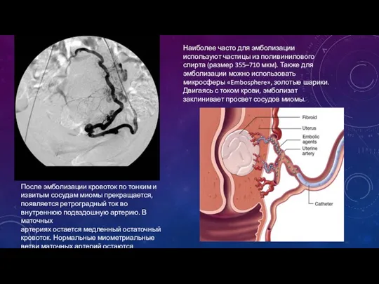 Наиболее часто для эмболизации используют частицы из поливинилового спирта (размер 355–710 мкм).