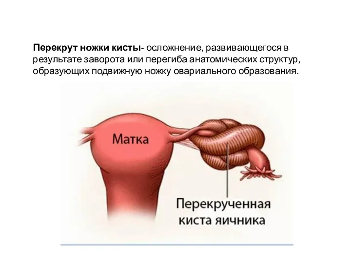 Перекрут ножки кисты- осложнение, развивающегося в результате заворота или перегиба анатомических структур,