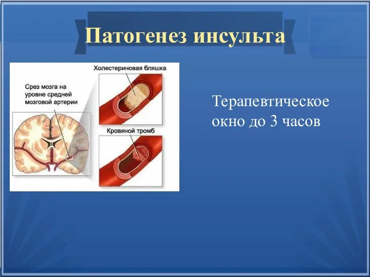 Патогенез инсульта Терапевтическое окно до 3 часов