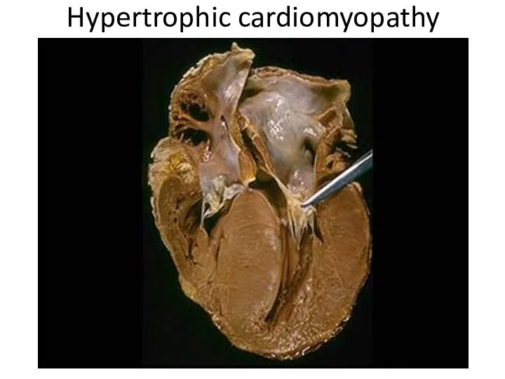 Hypertrophic cardiomyopathy