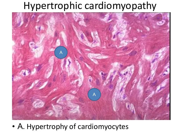 Hypertrophic cardiomyopathy А. Hypertrophy of cardiomyocytes А А