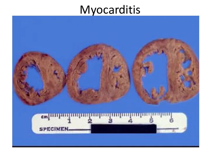 Myocarditis