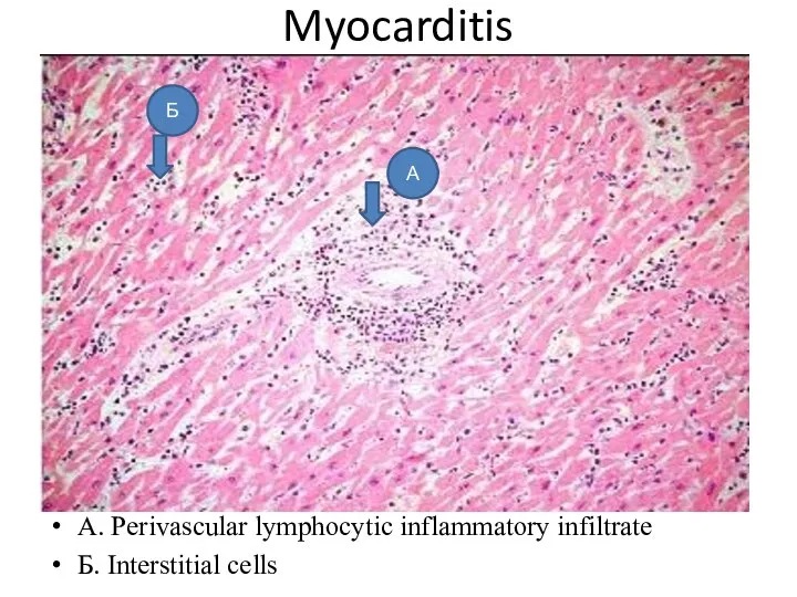 Myocarditis A. Perivascular lymphocytic inflammatory infiltrate Б. Interstitial cells А Б