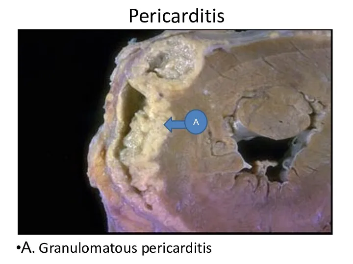 Pericarditis А. Granulomatous pericarditis А