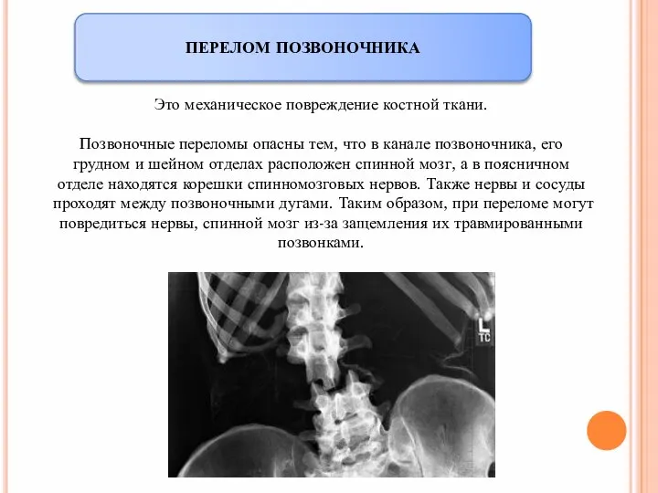 ПЕРЕЛОМ ПОЗВОНОЧНИКА Это механическое повреждение костной ткани. Позвоночные переломы опасны тем, что