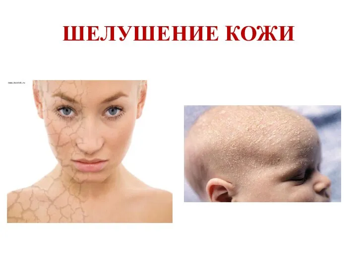 ШЕЛУШЕНИЕ КОЖИ