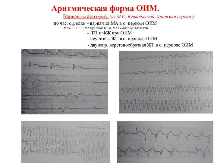 Аритмическая форма ОИМ. Варианты аритмий. (из М.С. Кушаковский. Аритмии сердца.) по час.