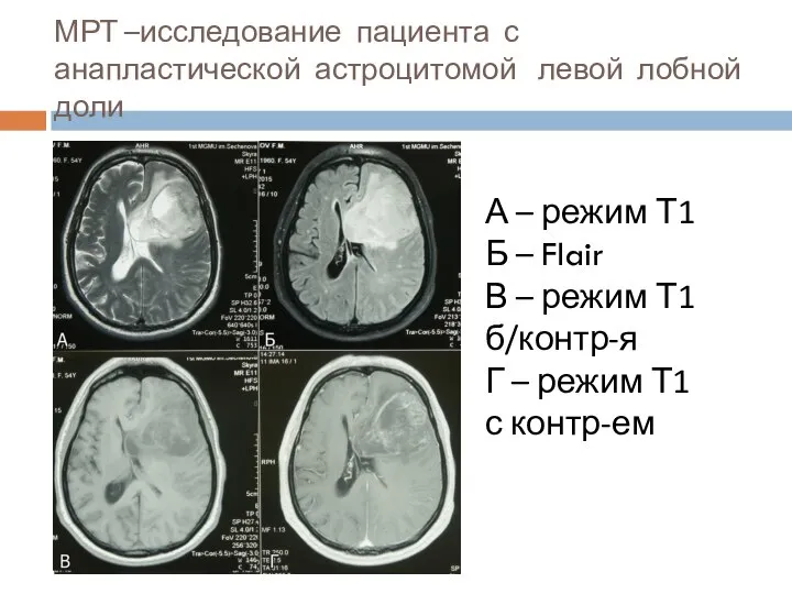 МРТ –исследование пациента с анапластической астроцитомой левой лобной доли А – режим