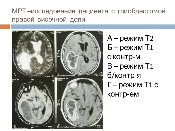 МРТ –исследование пациента с глиобластомой правой височной доли А – режим Т2