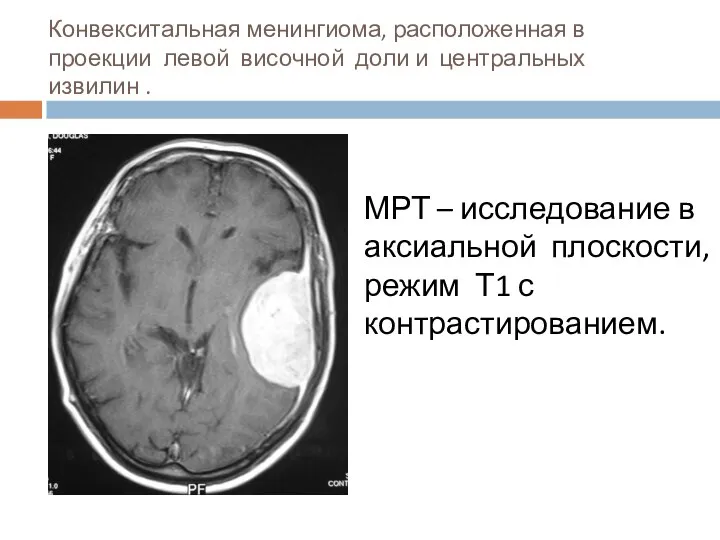 Конвекситальная менингиома, расположенная в проекции левой височной доли и центральных извилин .