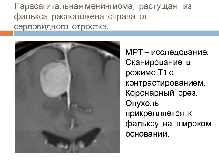 Парасагитальная менингиома, растущая из фалькса расположена справа от серповидного отростка. МРТ –