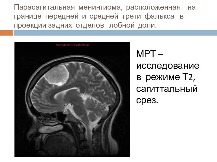 Парасагитальная менингиома, расположенная на границе передней и средней трети фалькса в проекции