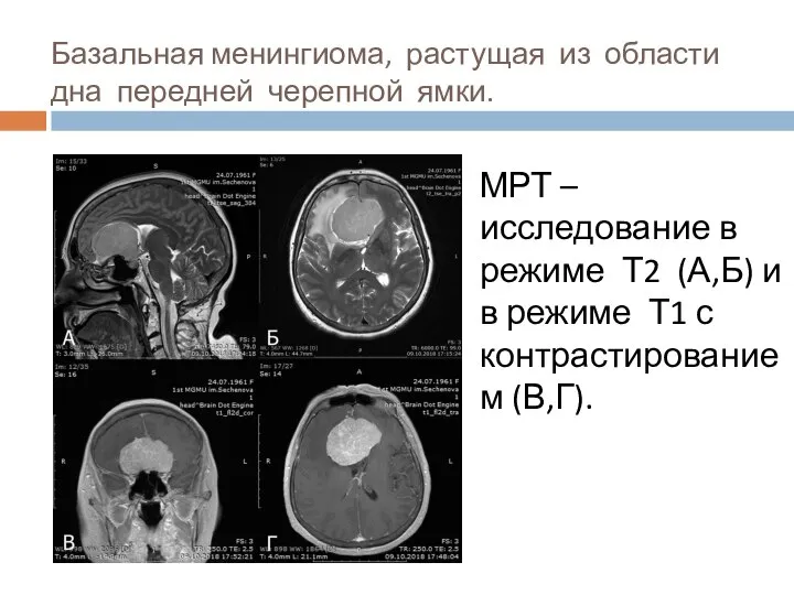 Базальная менингиома, растущая из области дна передней черепной ямки. МРТ – исследование