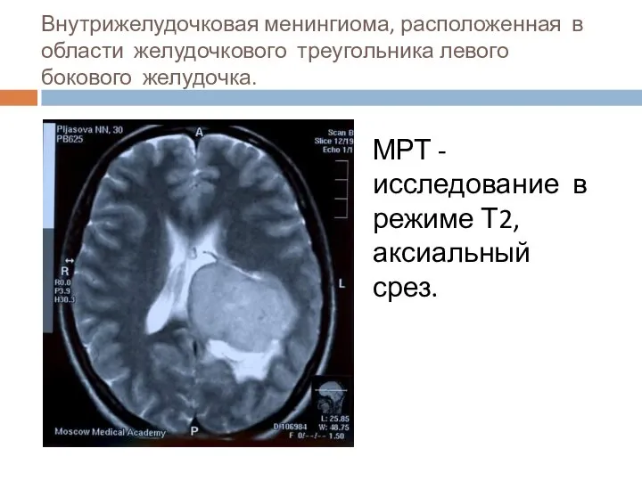 Внутрижелудочковая менингиома, расположенная в области желудочкового треугольника левого бокового желудочка. МРТ -