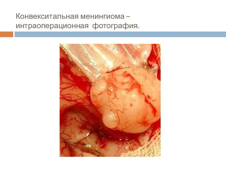 Конвекситальная менингиома – интраоперационная фотография.