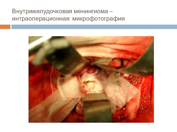 Внутрижелудочковая менингиома – интраоперационная микрофотография