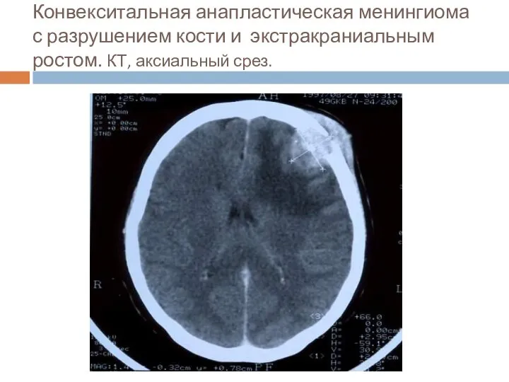 Конвекситальная анапластическая менингиома с разрушением кости и экстракраниальным ростом. КТ, аксиальный срез.