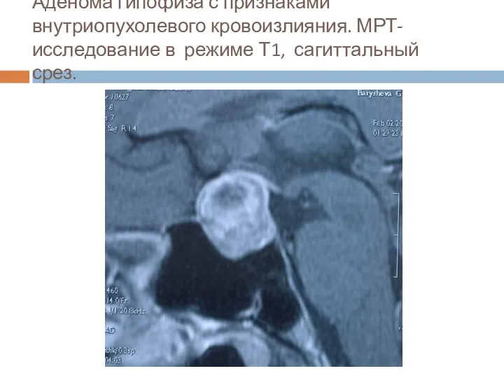 Аденома гипофиза с признаками внутриопухолевого кровоизлияния. МРТ- исследование в режиме Т1, сагиттальный срез.