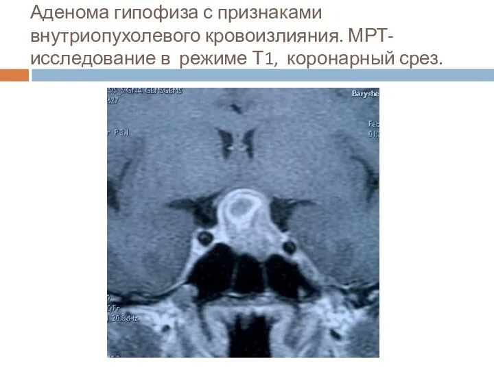 Аденома гипофиза с признаками внутриопухолевого кровоизлияния. МРТ- исследование в режиме Т1, коронарный срез.