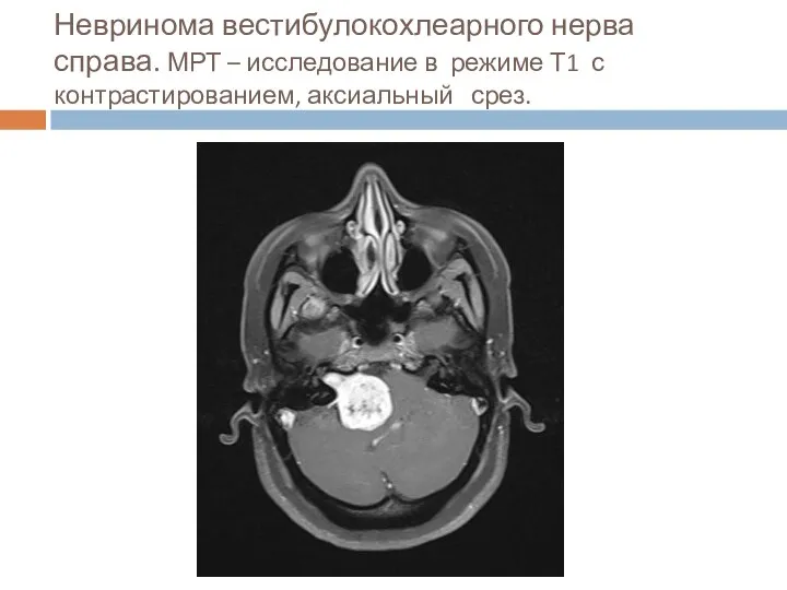 Невринома вестибулокохлеарного нерва справа. МРТ – исследование в режиме Т1 с контрастированием, аксиальный срез.