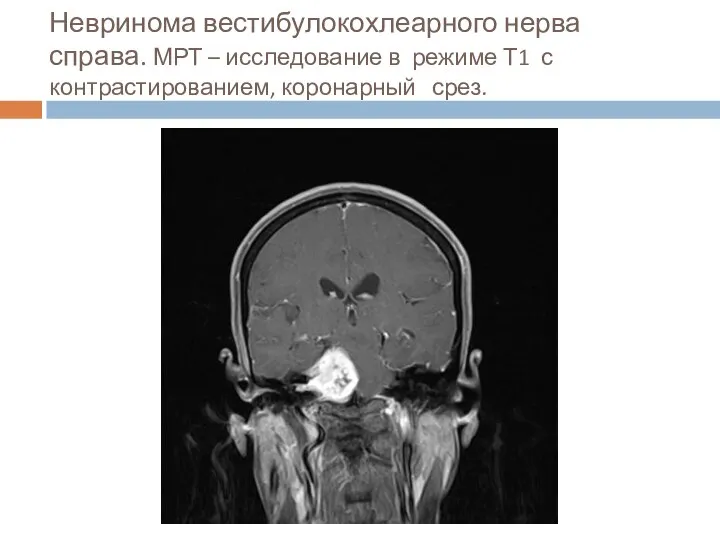 Невринома вестибулокохлеарного нерва справа. МРТ – исследование в режиме Т1 с контрастированием, коронарный срез.