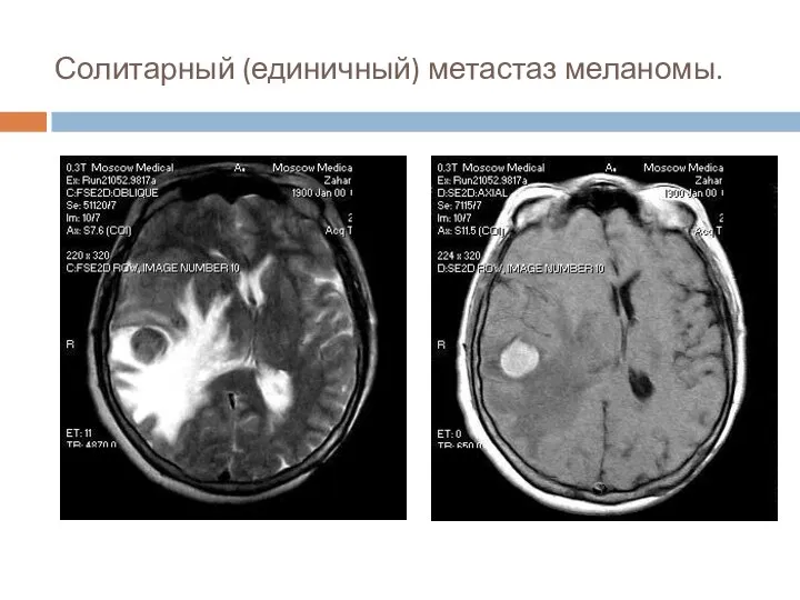 Солитарный (единичный) метастаз меланомы.