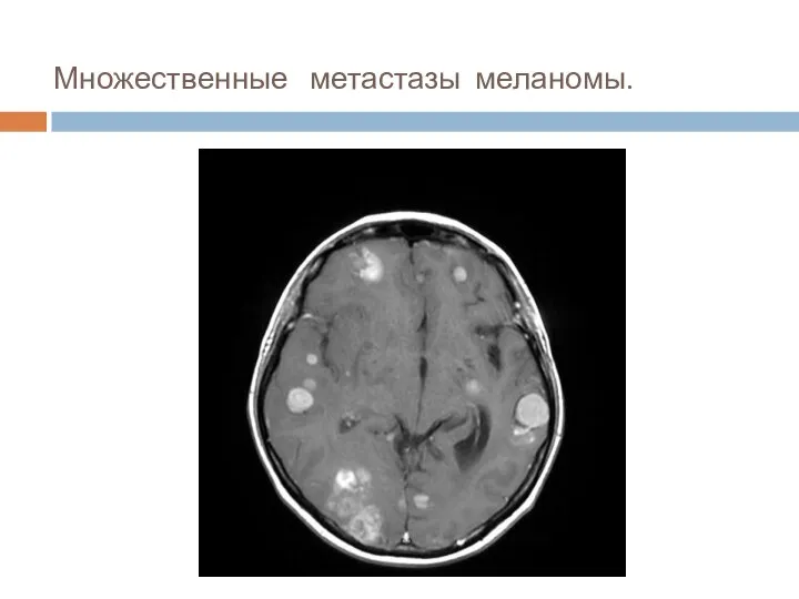 Множественные метастазы меланомы.