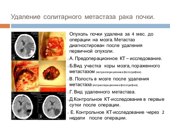 Удаление солитарного метастаза рака почки. Опухоль почки удалена за 4 мес. до