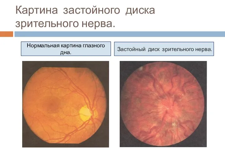 Картина застойного диска зрительного нерва. Нормальная картина глазного дна. Застойный диск зрительного нерва.