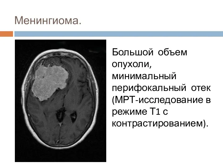 Менингиома. Большой объем опухоли, минимальный перифокальный отек (МРТ-исследование в режиме Т1 с контрастированием).