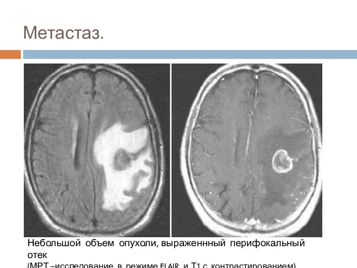 Метастаз. Небольшой объем опухоли, выраженнный перифокальный отек (МРТ –исследование в режиме FLAIR и Т1 с контрастированием).